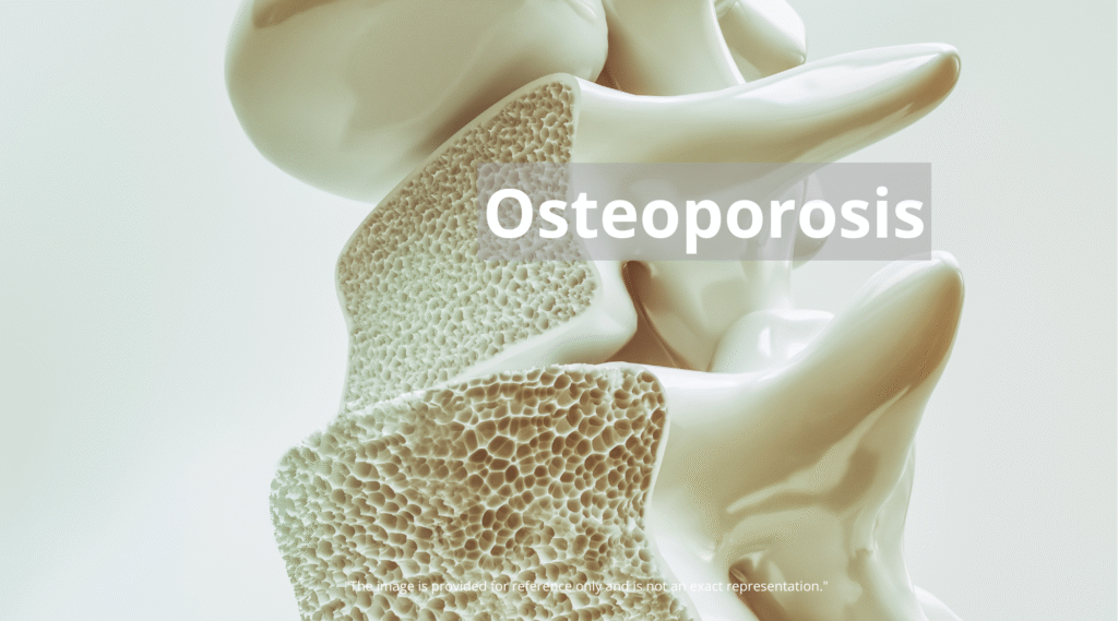 Be-Full-Be-HEALTH-2025-09-21T234058.431-1024x569 Reverse Osteoporosis? New Bone Strengthening Breakthroughs Offer Hope